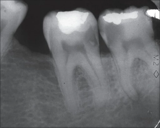 Caries interproximal en radiografía de aleta de mordida